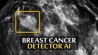 DeepMind’s New AI Helps Detecting Breast Cancer