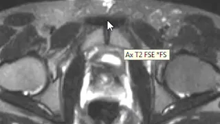 Athletic Pubalgia - Sports Hernia 2