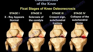 Osteonecrosis Of The Knee - Everything You Need To Know - Dr. Nabil Ebraheim