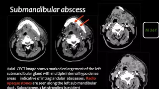 Imaging of Head and Neck Infections II   DRE 18   Dr  Mamadouh Mahfouz