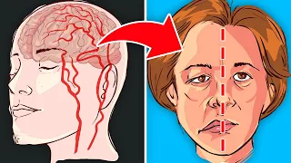 9 Lebensmittel, die du essen solltest, um einem Schlaganfall vorzubeugen