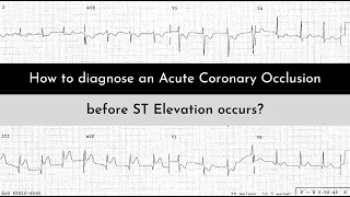 STEMI-NSTEMI vs OMI-NOMI: A Paradigm Shift in ECG interpretation of MI