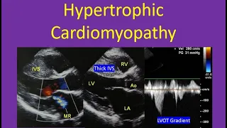 Hypertrophic Cardiomyopathy