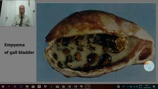 Biliary surgery 7 (Acute  cholecystitis 1, aetiology & pathology ) , by Dr. Wahdan