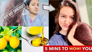 1 WASH CHALLENGE : Get Rid of EXTREME DANDRUFF & HAIR FALL Permanently At Home  | 100% Results