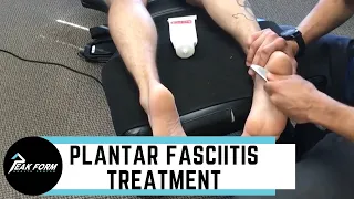 Plantar Fasciitis Treatment San Diego Graston, Chiropractic