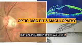 Optic Disc Pit (ODP) & Optic Disc Pit Maculopathy (ODPM) - Clinical picture and OCT