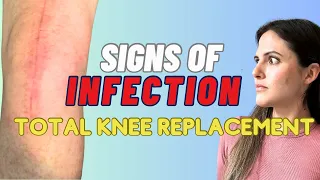 Signs & Symptoms Of Infection After A Knee Replacement (MUST WATCH!)