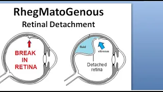 Ophthalmology 308 Rhegmatogenous Retinal Detachment Primary Complication Treatment Marcus Gunn Pupil