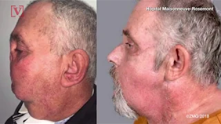 64-Year-Old Becomes Oldest Person to Receive Face Transplant