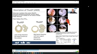 UROwebinar: Laser Endoscopic Anatomic Enucleation of Prostate (AEEP)