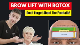 Brow Lift With Botox -  Botox Injection Patterns | Botox Brow Lift Advice