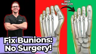 TOP 13 Ways to Shrink Bunions Naturally [+1 HUGE SECRET!]