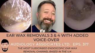 EAR WAX REMOVALS 3&4 WITH ADDED VOICEOVER - EP 317