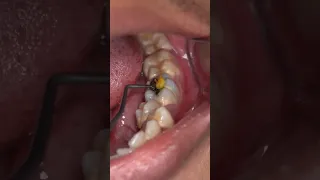 You’ll Never Guess What’s In This Tooth..