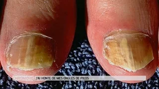 J'ai honte de mes ongles de pieds, que faire ? - Le Magazine de la santé