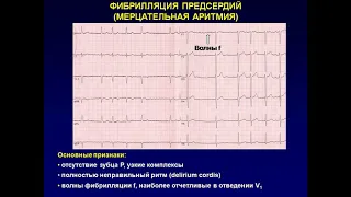 Фибрилляция предсердий