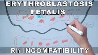 Erythroblastosis fetalis | Rh Incompatibility