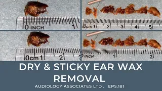 DRY AND STICKY EAR WAX REMOVAL - EP181