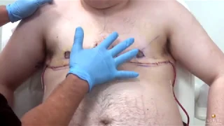 FTM Top Surgery / Double Incision Surgery | Removing free nipple graft bolsters