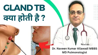 Gland TB क्या होती है ? Gland Tuberculosis #drnaveenailawadi #tbdoctor #lungdoctor #lungfitbodyfit