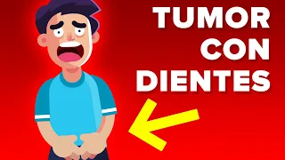 Hombre Desarrolla Tumor con Dientes dentro de los Testículos.