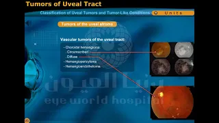 classification of uveal tumors