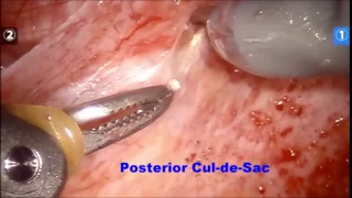 Robotic Cerclage at 13 weeks gestation