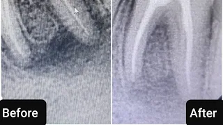 Infection at tooth apex. Can we obturate?