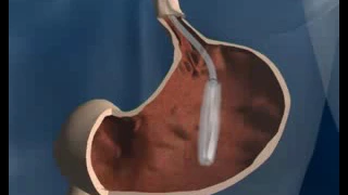 Gastric Balloon Placement