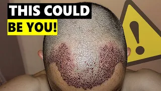 5 Things Went Incredibly Wrong with His Hair Transplant!
