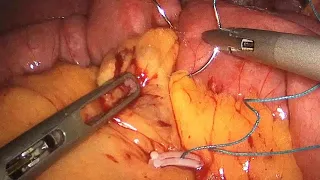 Mesenteric defects closure during RYGB