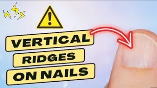 what causes vertical ridges on nails.that is the real cause of vertical ridges on your nails#reels