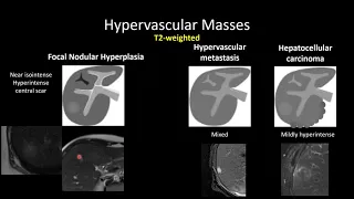HyperVascular Masses of the Liver