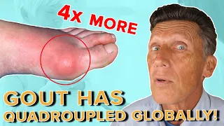 Why Gout has Quadrupled Globally in 40 years: How to reverse it