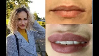 Увеличение губ гиалуроновой кислотой💋Губы💋Вся правда об увеличении губ