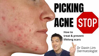 Picking acne | How to treat to prevent lifelong scars