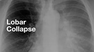 Lobar Collapse (examples of each lobe)