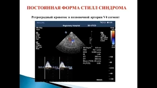 Ультразвуковая диагностика патологии вертебро-базилярной системы