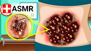 ASMR removal dog ticks & maggot infection belly animation | ASMR Treatment Animation @asmrtvpro