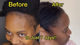 HOW I GOT MY HAIRLINE BACK IN 1 WEEK!! HAIR GROWTH | SAMUPERTY