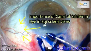 IMPORTANCE OF SCHLEMM CANAL IN TRABECULECTOMY