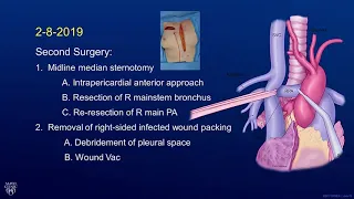 Blackmon R Pneumonectomy w BP Fistula 2020