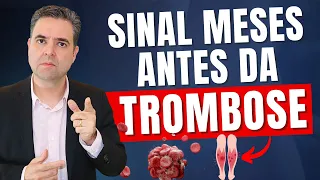 SINAL de ALERTA antes de uma TROMBOSE + 5 ATITUDES para prevenir | Dr. Alex Vascular