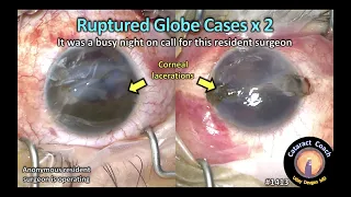 CataractCoach 1413: ruptured globe repair / corneal laceration