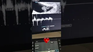 Dr sci. med. Aleksandra Novakov - Utvrđivanje trudnoće ultrazvukom