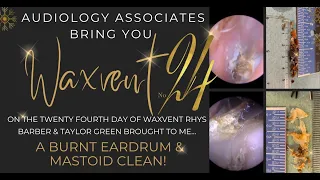 BURNT EARDRUM & MASTOID CAVITY CLEAN - EP543