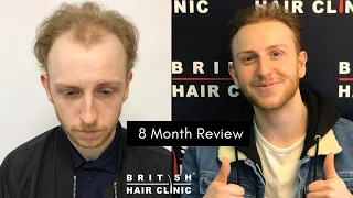 The British Hair Clinic - James very happy at his 8 month review in February