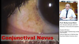 Conjunctival Nevus