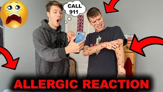 ALLERGIC REACTION PRANK ON TWIN BROTHER (HE CALLED 911)